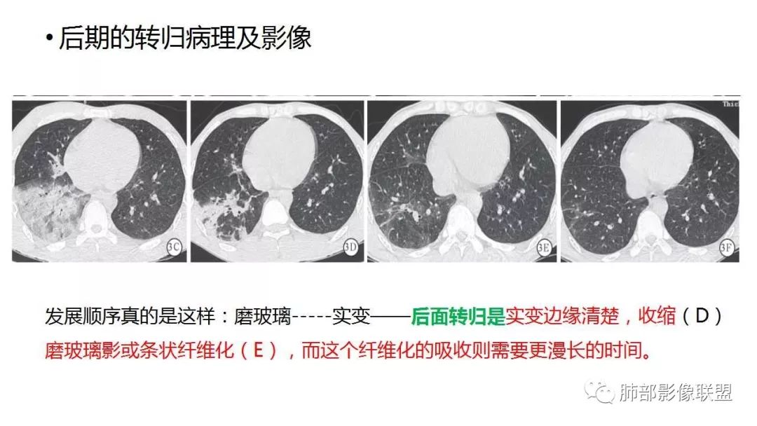 【PPT】病毒性肺炎影像诊断