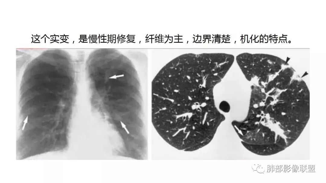 【PPT】病毒性肺炎影像诊断
