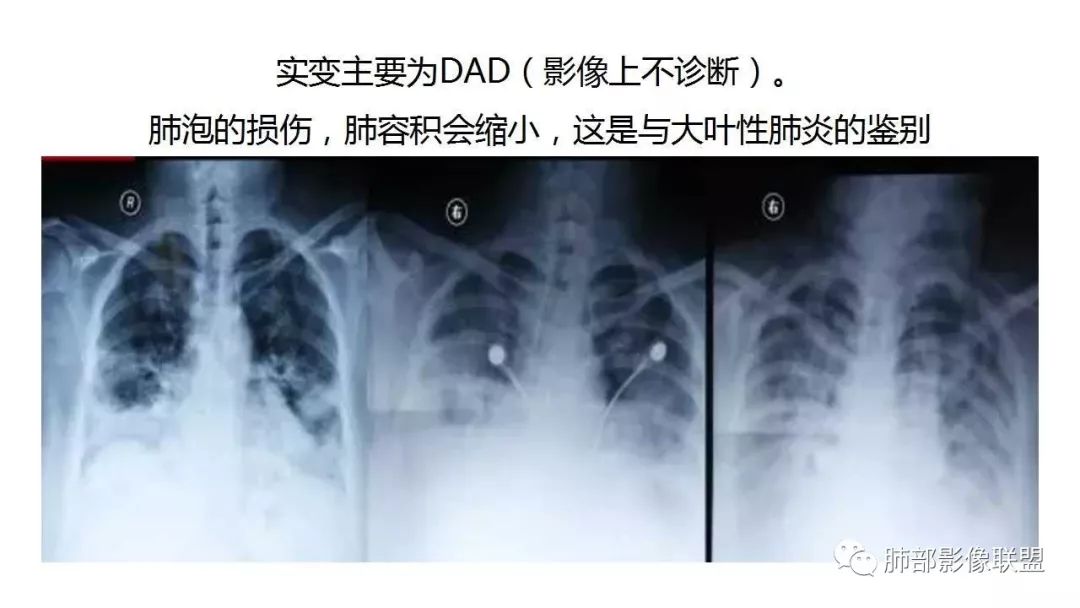 【PPT】病毒性肺炎影像诊断
