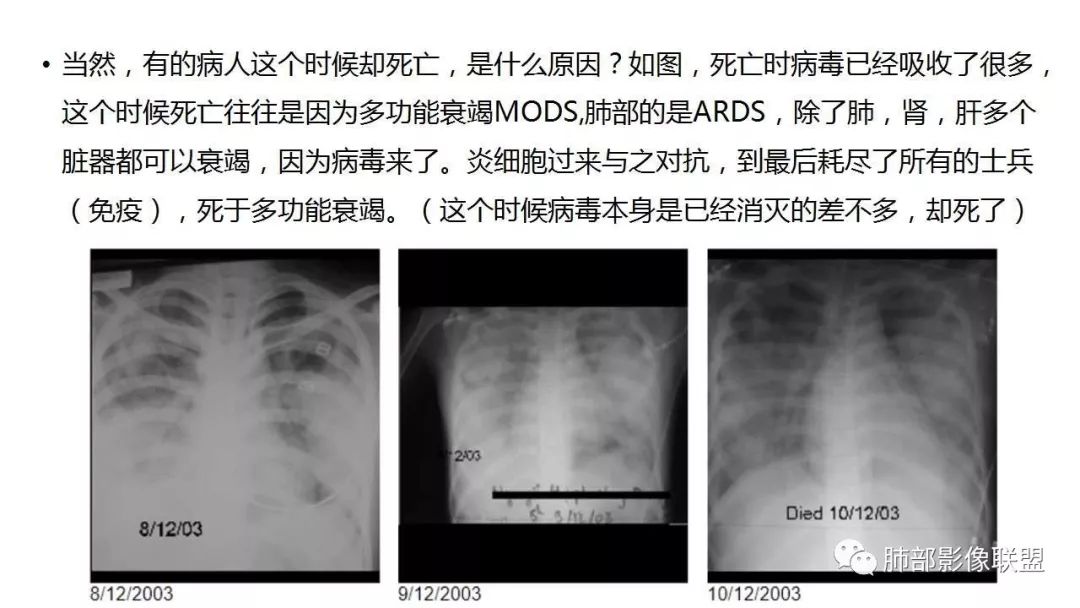 【PPT】病毒性肺炎影像诊断