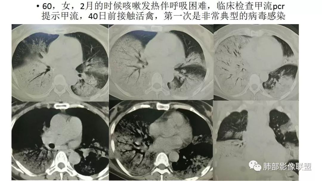 【PPT】病毒性肺炎影像诊断