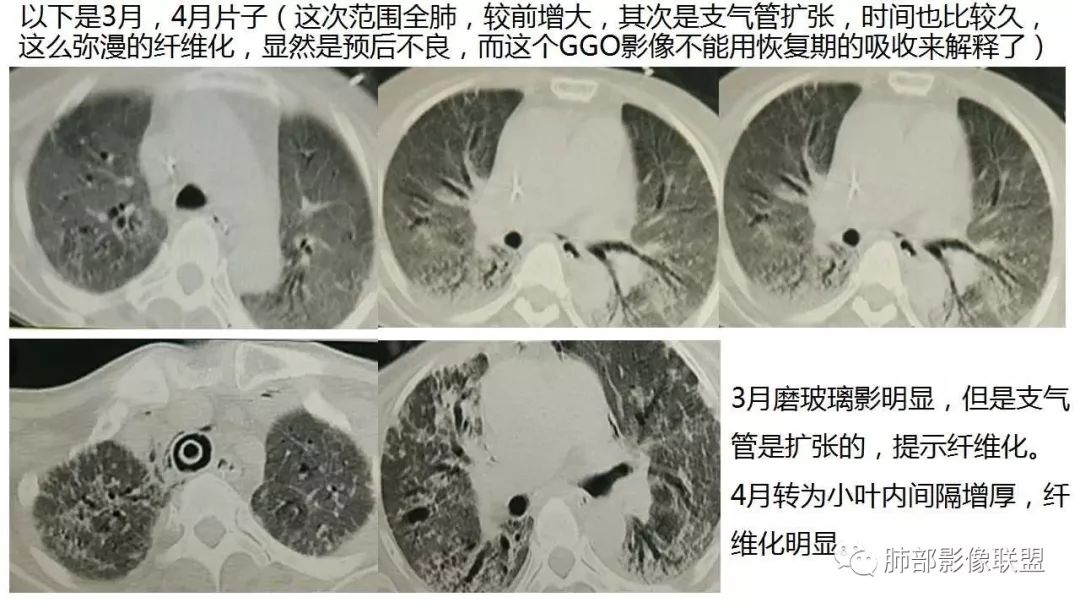 【PPT】病毒性肺炎影像诊断