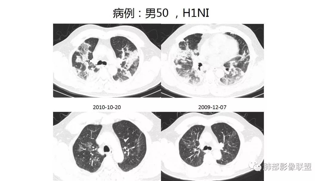 【PPT】病毒性肺炎影像诊断