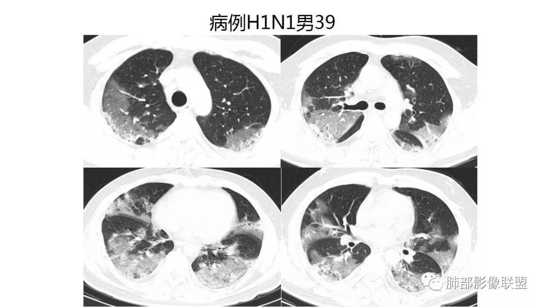【PPT】病毒性肺炎影像诊断