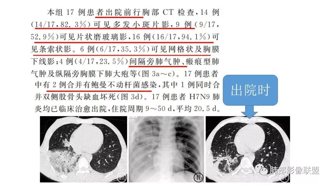 【PPT】病毒性肺炎影像诊断