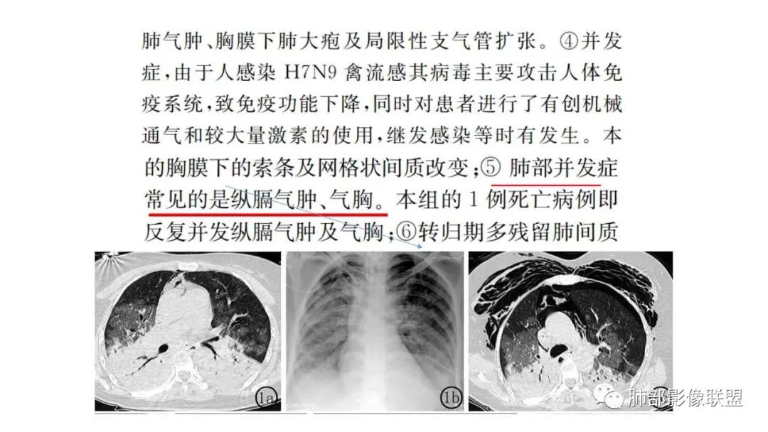 【PPT】病毒性肺炎影像诊断