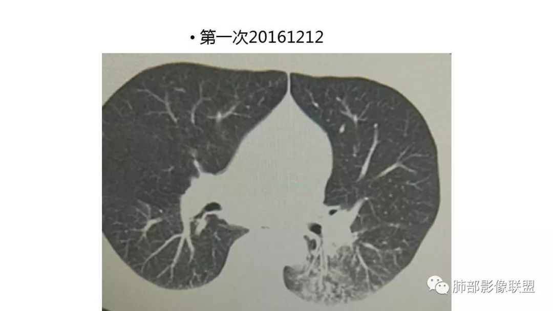【PPT】病毒性肺炎影像诊断