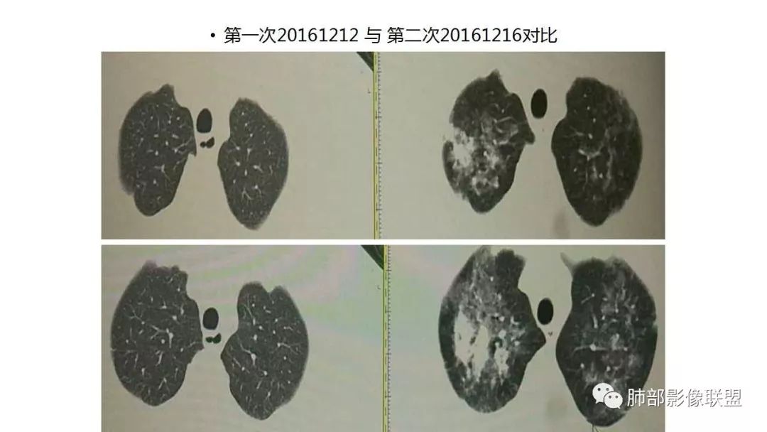 【PPT】病毒性肺炎影像诊断