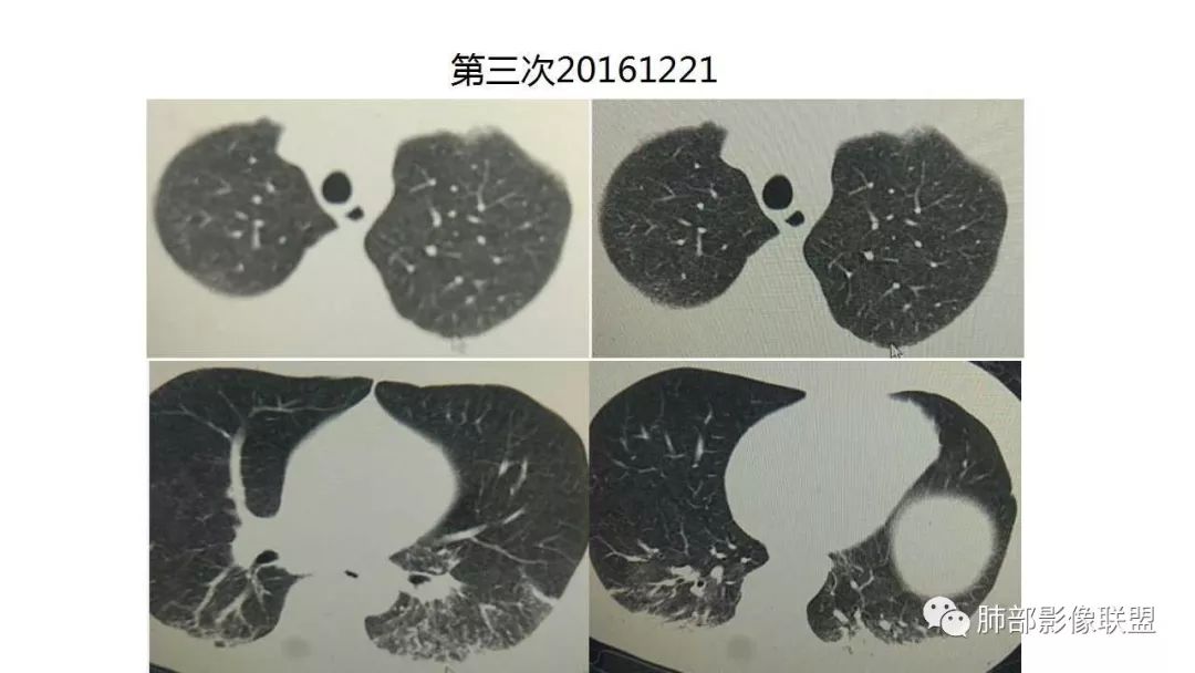 【PPT】病毒性肺炎影像诊断