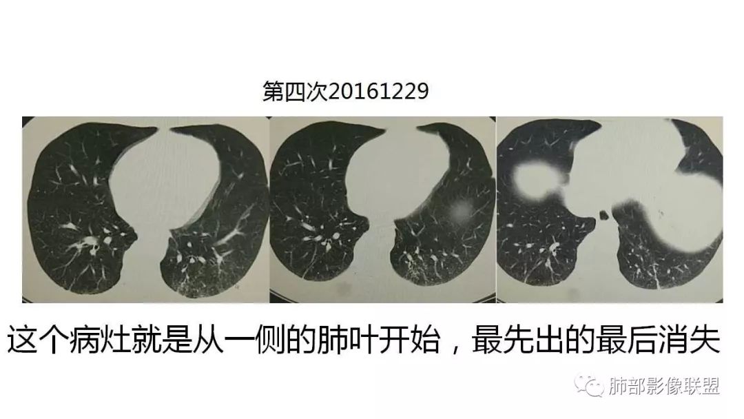 【PPT】病毒性肺炎影像诊断