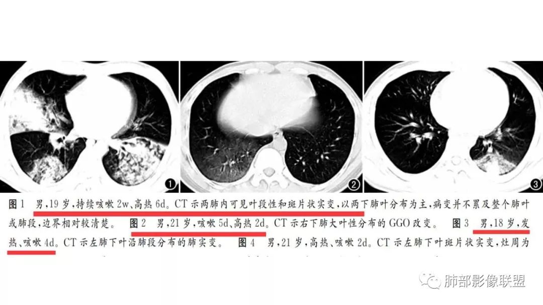【PPT】病毒性肺炎影像诊断