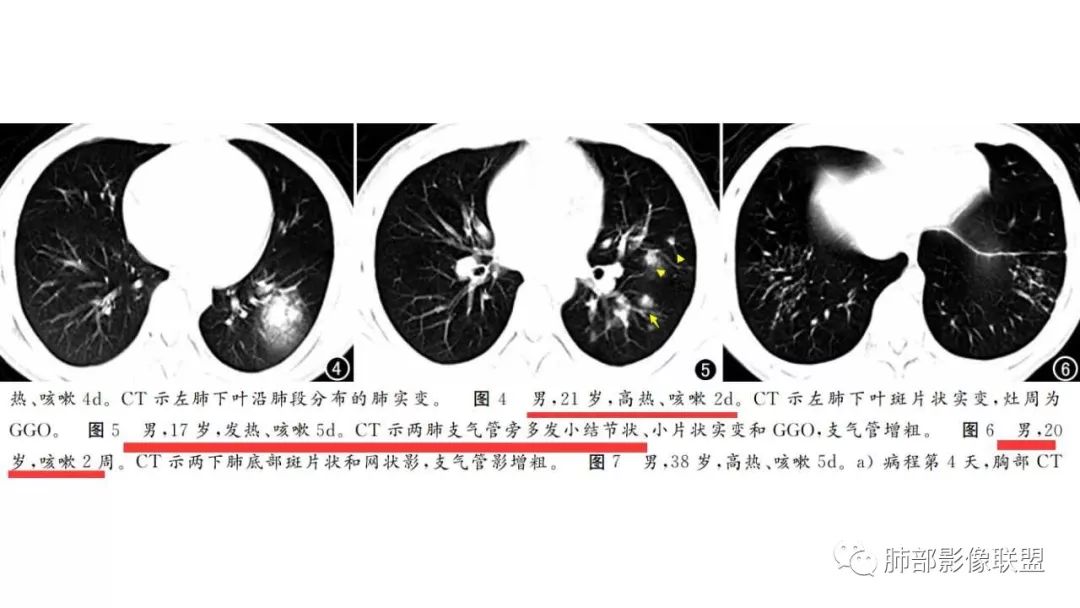 【PPT】病毒性肺炎影像诊断