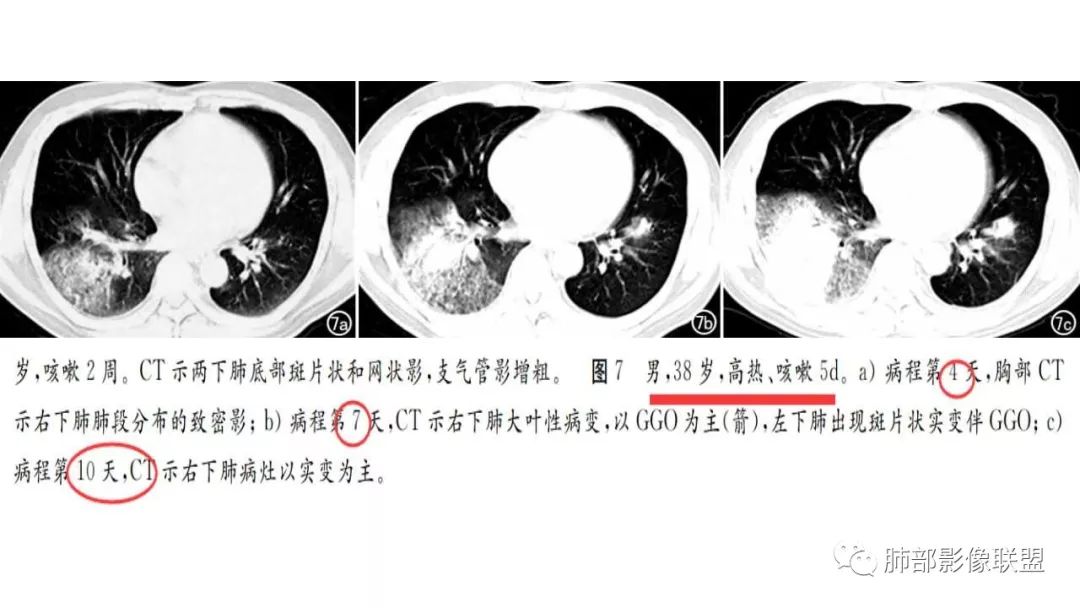 【PPT】病毒性肺炎影像诊断