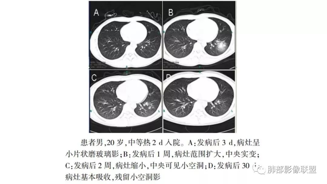 【PPT】病毒性肺炎影像诊断