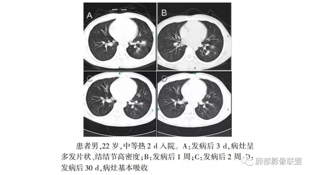 【PPT】病毒性肺炎影像诊断