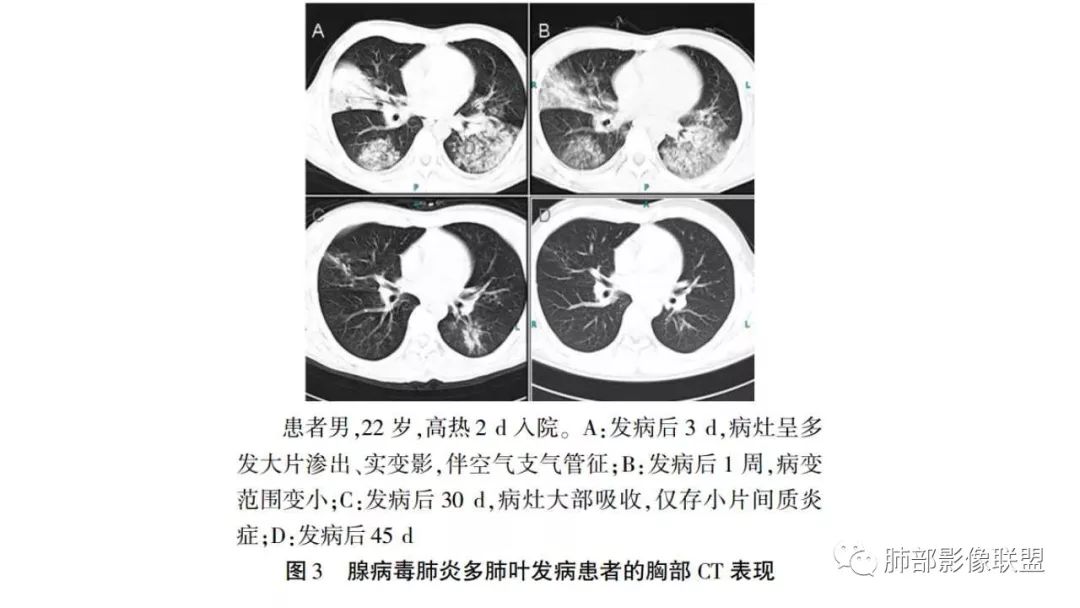 【PPT】病毒性肺炎影像诊断