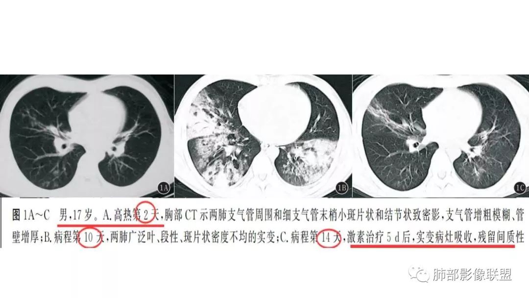 【PPT】病毒性肺炎影像诊断