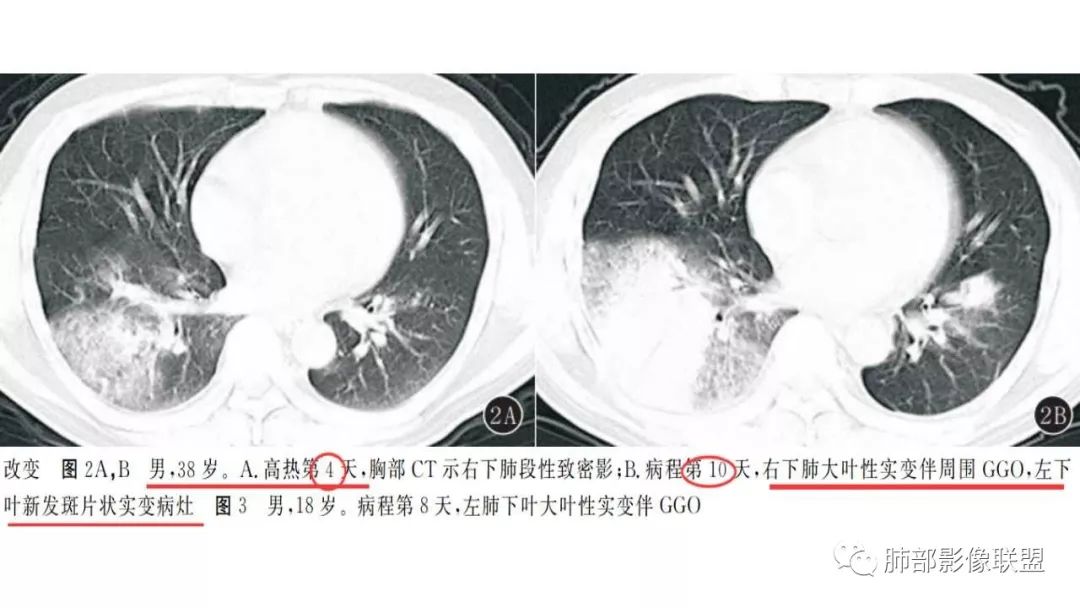 【PPT】病毒性肺炎影像诊断