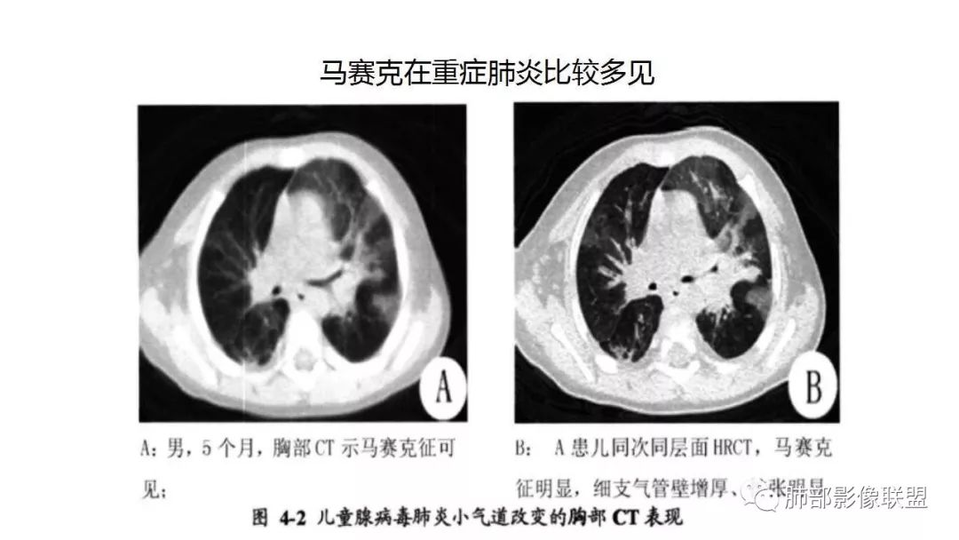 【PPT】病毒性肺炎影像诊断