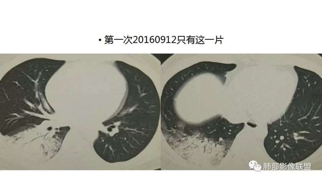 【PPT】病毒性肺炎影像诊断