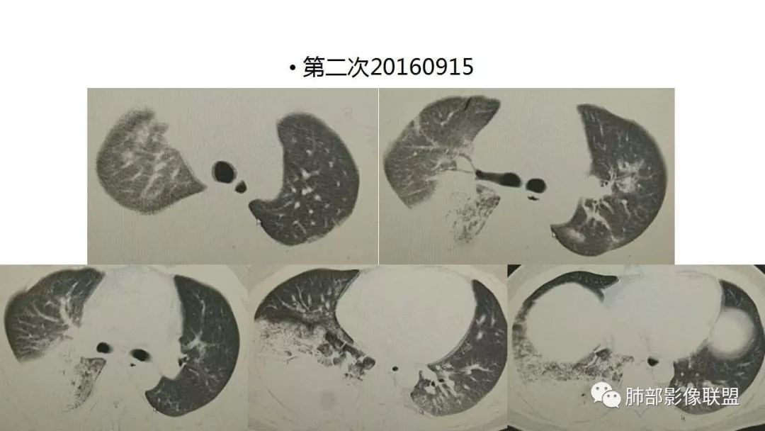 【PPT】病毒性肺炎影像诊断