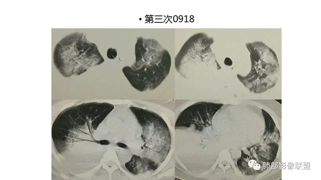 【PPT】病毒性肺炎影像诊断