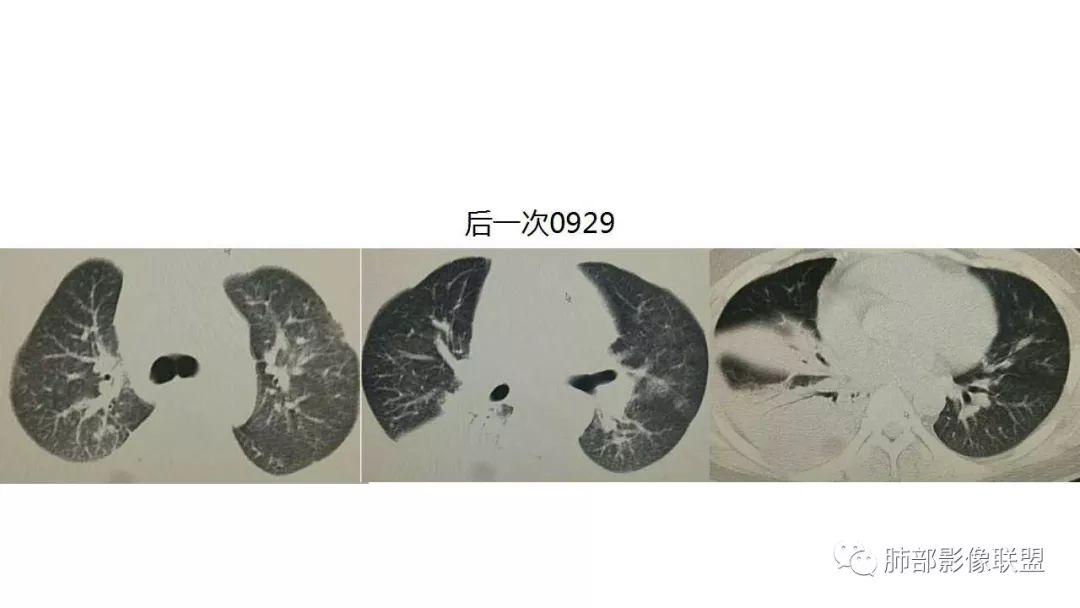 【PPT】病毒性肺炎影像诊断
