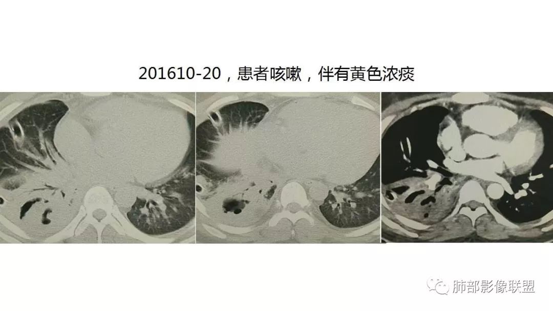 【PPT】病毒性肺炎影像诊断