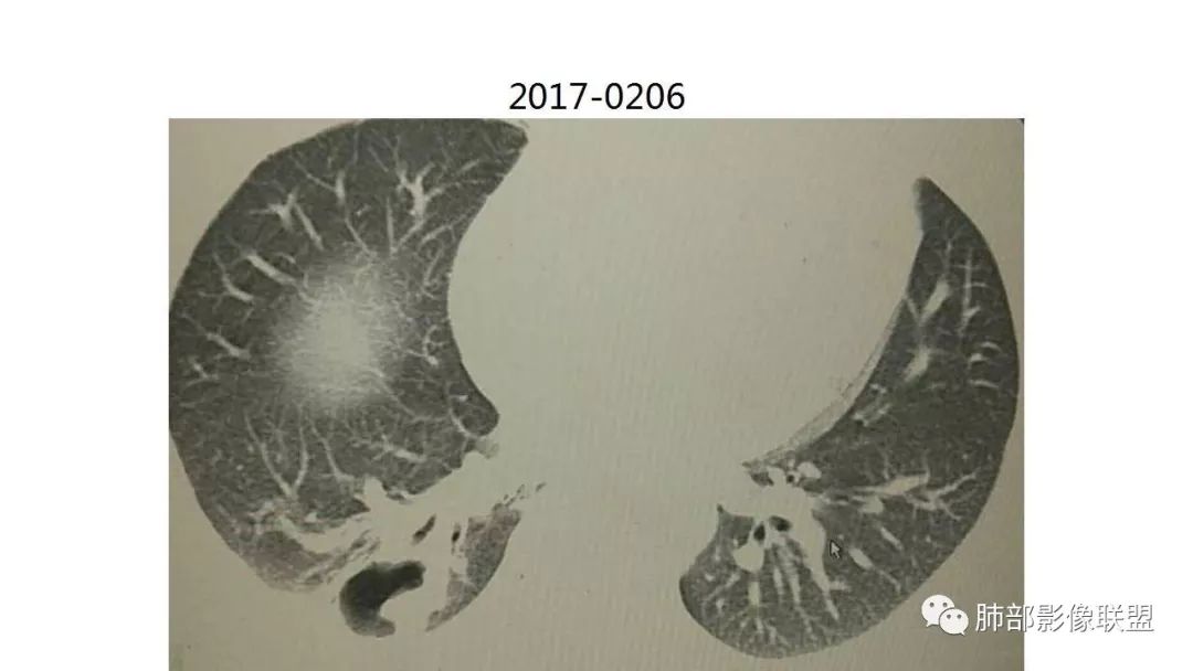 【PPT】病毒性肺炎影像诊断