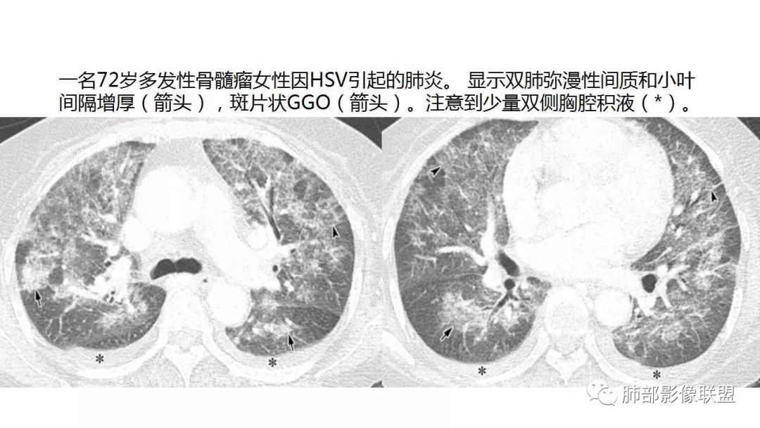 【PPT】病毒性肺炎影像诊断