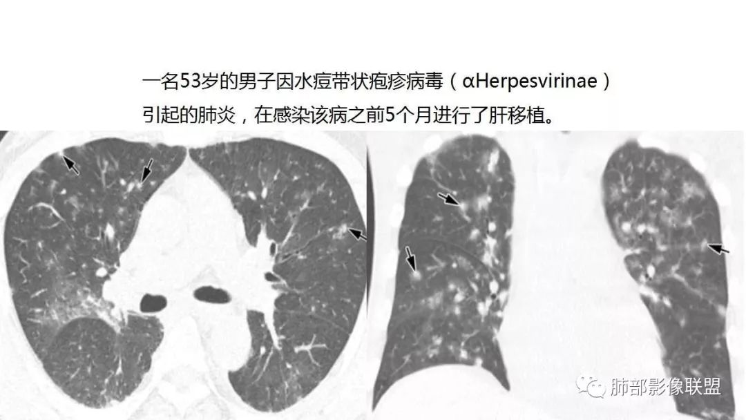 【PPT】病毒性肺炎影像诊断