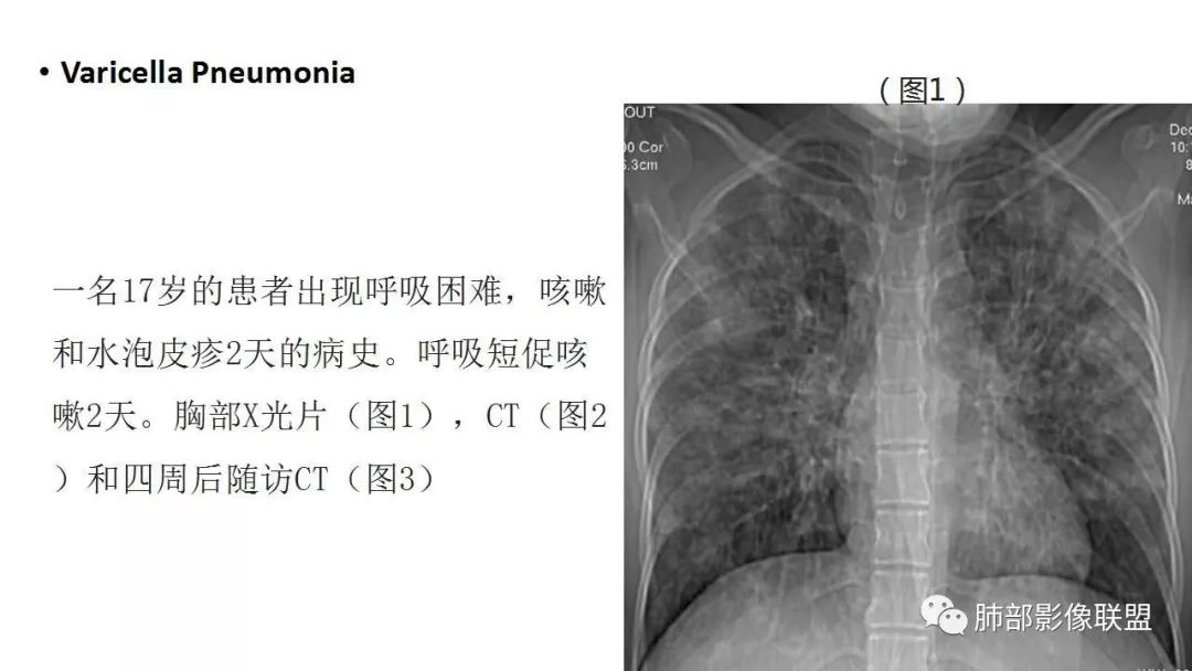 【PPT】病毒性肺炎影像诊断
