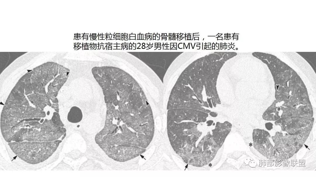 【PPT】病毒性肺炎影像诊断