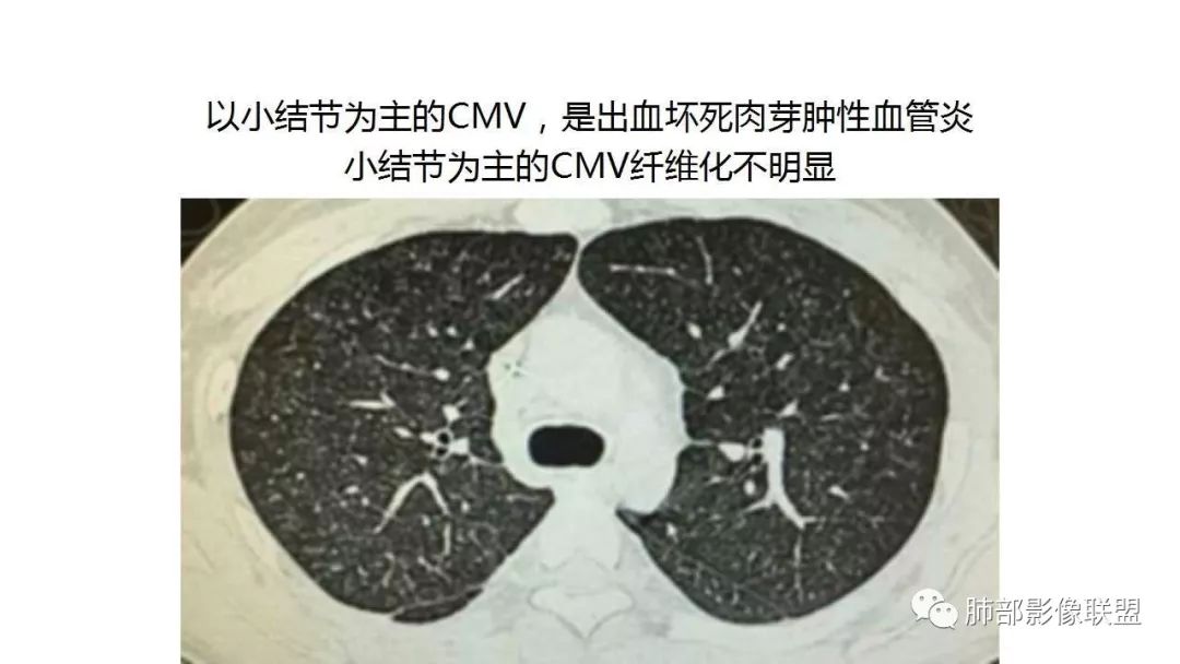 【PPT】病毒性肺炎影像诊断