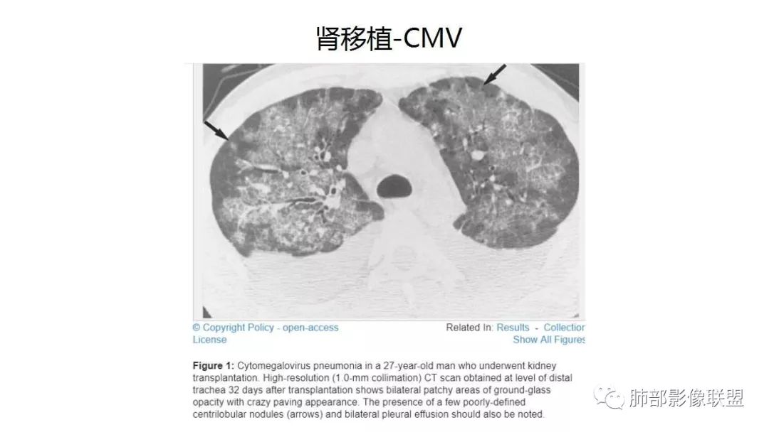 【PPT】病毒性肺炎影像诊断