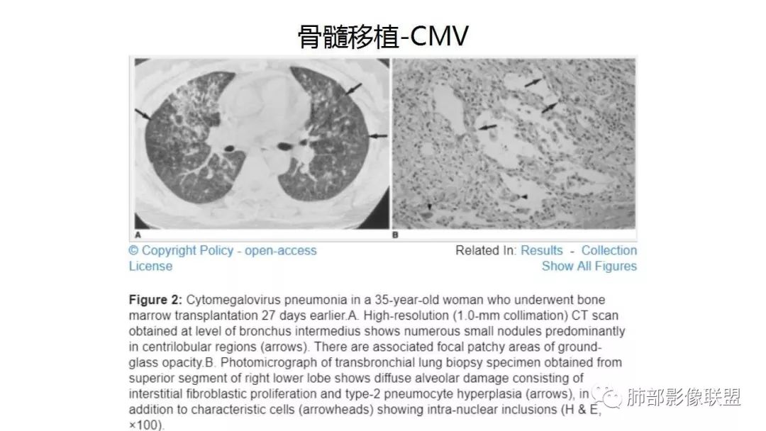 【PPT】病毒性肺炎影像诊断