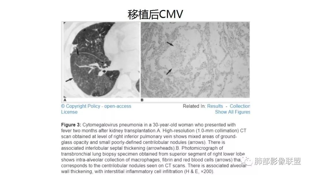 【PPT】病毒性肺炎影像诊断