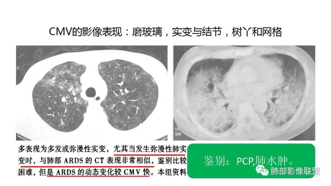 【PPT】病毒性肺炎影像诊断