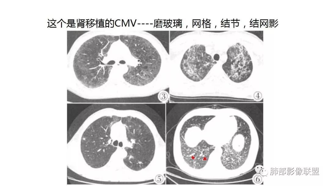 【PPT】病毒性肺炎影像诊断
