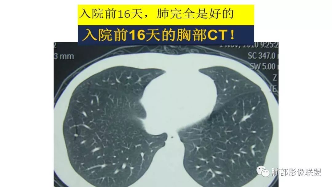【PPT】病毒性肺炎影像诊断