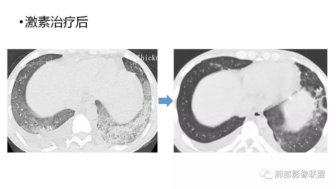 【PPT】病毒性肺炎影像诊断