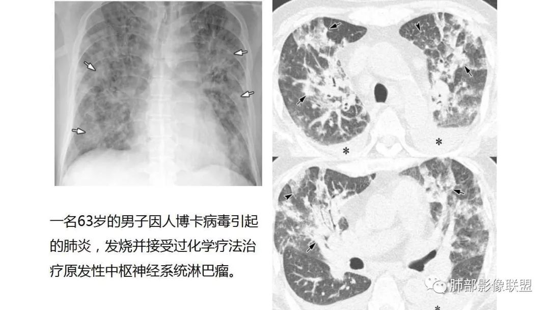 【PPT】病毒性肺炎影像诊断