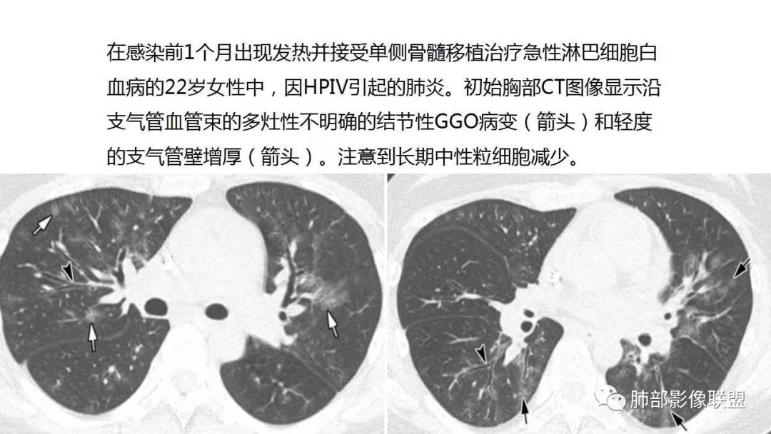 【PPT】病毒性肺炎影像诊断