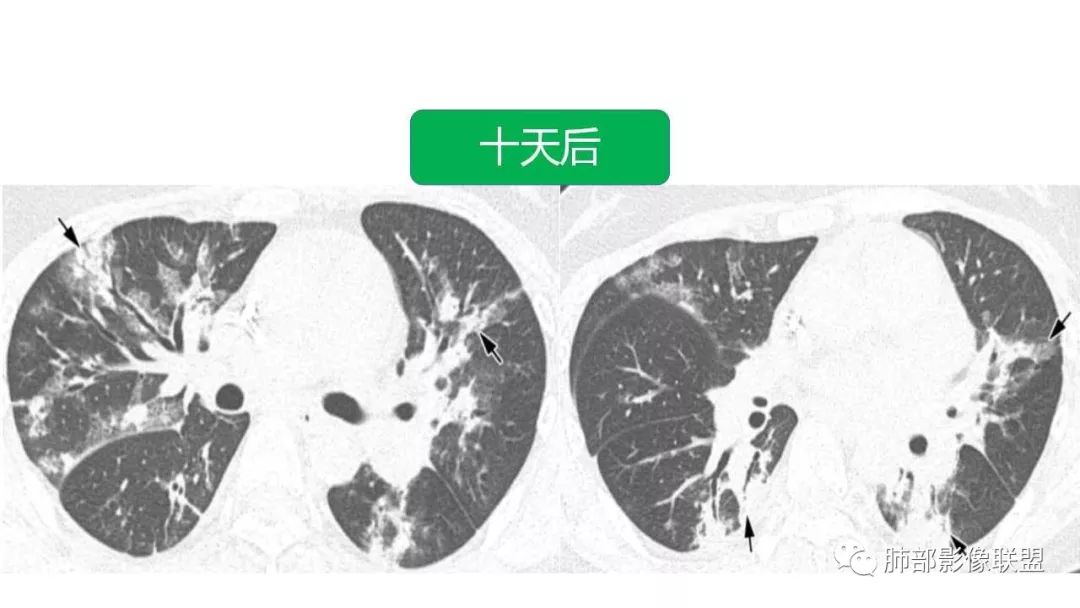 【PPT】病毒性肺炎影像诊断