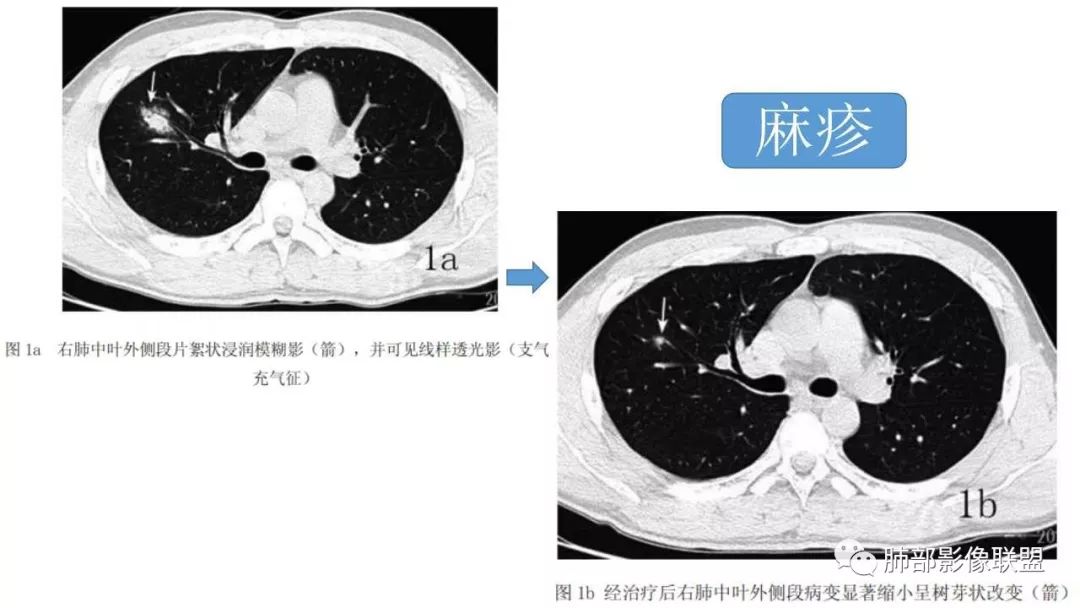 【PPT】病毒性肺炎影像诊断