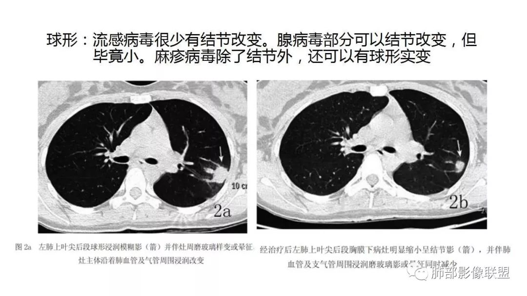 【PPT】病毒性肺炎影像诊断