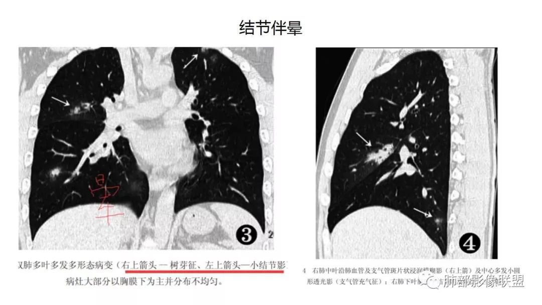 【PPT】病毒性肺炎影像诊断