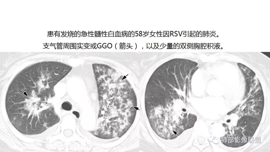 【PPT】病毒性肺炎影像诊断
