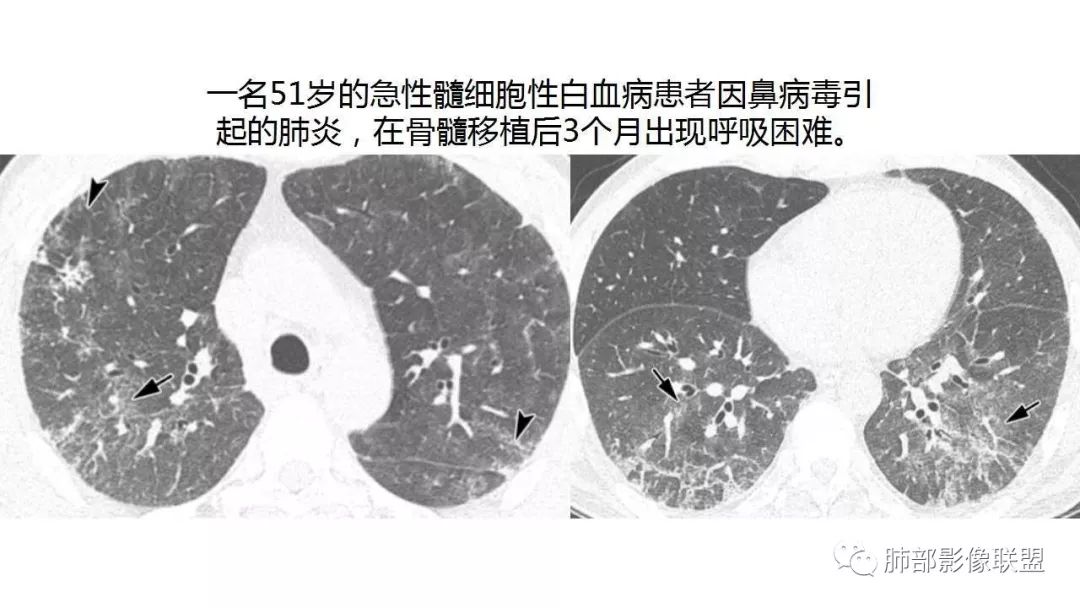 【PPT】病毒性肺炎影像诊断