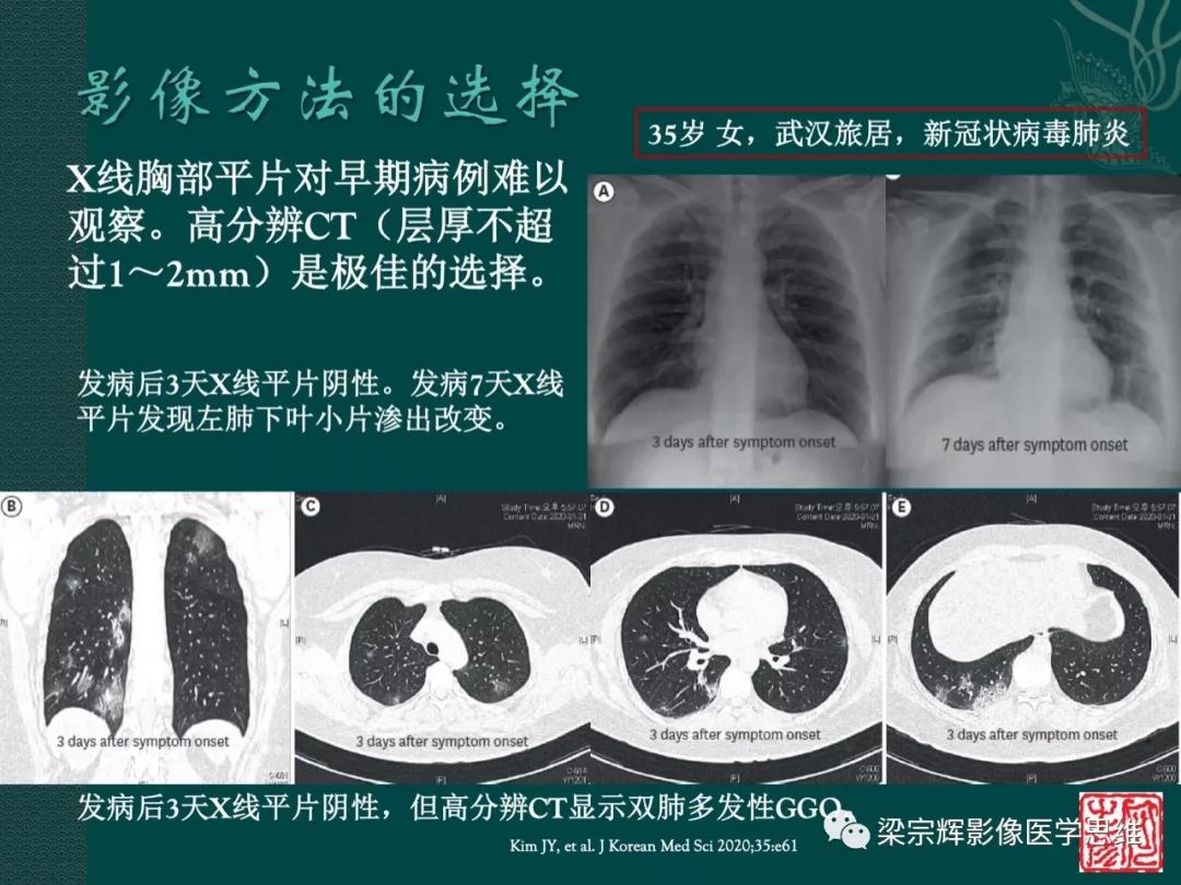 【PPT】新型冠状病毒（COVID-19）肺炎概念与CT表现